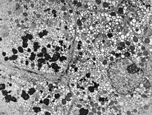 M,17y. | hyperbilirubinaemia - lipofuscin - Gilbert or Dubin-Johnson syndrome